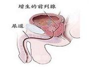 什么是前列腺增生，怎样预防和治疗前列腺增生